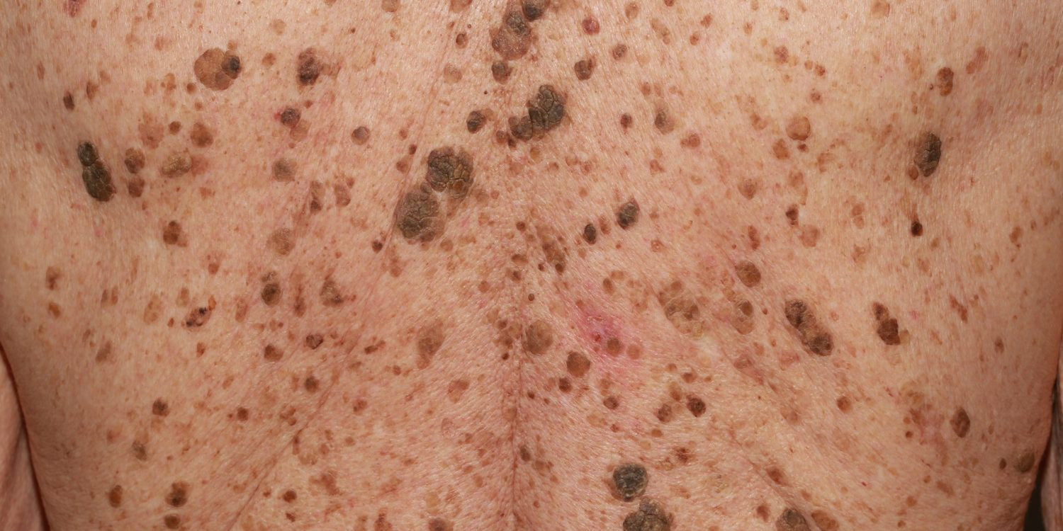 Keratosis Seboroik / Keratosis Senilis